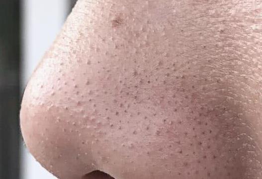 好久没注意鼻子了，全是黑乎乎的黑头，一挤全是“黄色”的油脂条，怎么办？