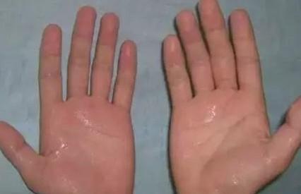 大病到来，“手”先知，手上出现4种表现要就医，指的是什么？